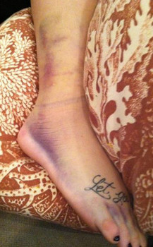 demi lovato shows bruises from fall, how to 